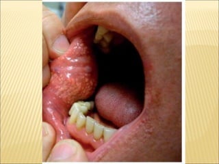 Epitelial cubierta y revestimiento