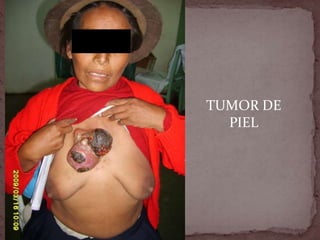 HERIDA OPERATORIA INFECTADA