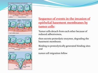 Epithelial and mesenchymal transition in invasion and metastasis | PPTX