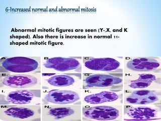6-Increased normal and abnormal mitosis
Abnormal mitotic figures are seen (Y-,X, and K
shaped). Also there is increase in normal 11-
shaped mitotic figure.
 