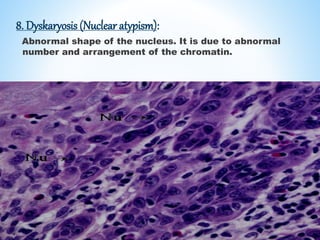 8. Dyskaryosis (Nuclear atypism):
Abnormal shape of the nucleus. It is due to abnormal
number and arrangement of the chromatin.
 