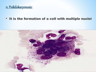 11. Poikilokaryonosis:
• It is the formation of a cell with multiple nuclei
 