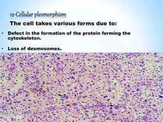 12-Cellular pleomorphism
The cell takes various forms due to:
• Defect in the formation of the protein forming the
cytoskeleton.
• Loss of desmosomes.
 