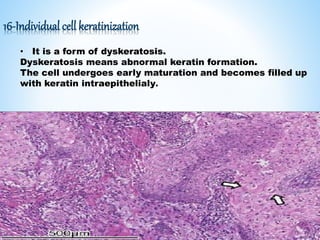 16-Individual cell keratinization
• It is a form of dyskeratosis.
Dyskeratosis means abnormal keratin formation.
The cell undergoes early maturation and becomes filled up
with keratin intraepithelialy.
 