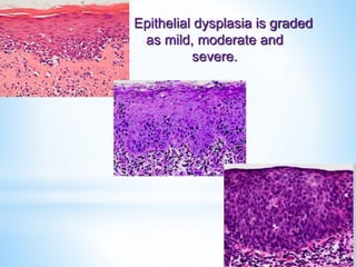 Epithelial dysplasia is graded
as mild, moderate and
severe.
 