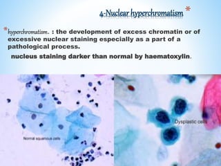 *4-Nuclear hyperchromatism
*hyperchromatism. : the development of excess chromatin or of
excessive nuclear staining especially as a part of a
pathological process.
nucleus staining darker than normal by haematoxylin.
 