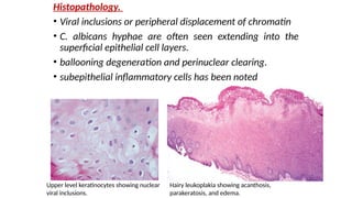 Perinuclear Inclusions Epithelial lesions types and characteristic features | PPTX