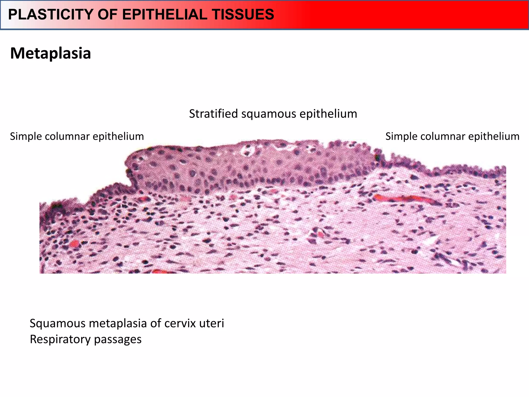 Metaplasia
Squamous metaplasia of cervix uteri
Respiratory passages
Simple columnar epithelium
Stratified squamous epithelium
Simple columnar epithelium
PLASTICITY OF EPITHELIAL TISSUES
 