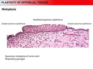 Metaplasia
Squamous metaplasia of cervix uteri
Respiratory passages
Simple columnar epithelium
Stratified squamous epithelium
Simple columnar epithelium
PLASTICITY OF EPITHELIAL TISSUES
 
