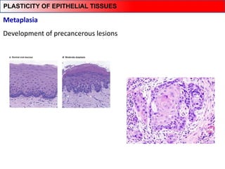 Metaplasia
Development of precancerous lesions
PLASTICITY OF EPITHELIAL TISSUES
 