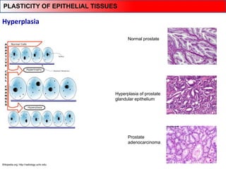 Wikipedia.org; http://radiology.uchc.edu
Hyperplasia
Normal prostate
Hyperplasia of prostate
glandular epithelium
Prostate
adenocarcinoma
PLASTICITY OF EPITHELIAL TISSUES
 