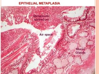 EPITHELIAL METAPLASIA
 
