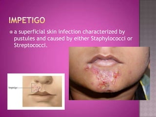 a superficial skin infection characterized by
 pustules and caused by either Staphylococci or
 Streptococci.
 