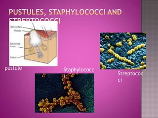 pustule   Staphylococc
          i              Streptococ
                         ci
 