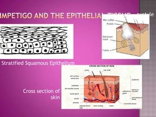 pustule




Stratified Squamous Epithelium




        Cross section of
                    skin
 