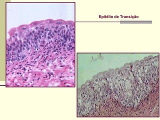 Epitélio de Transição
 
