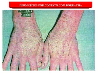 20
DERMATITES POR CONTATO COM BORRACHA
 