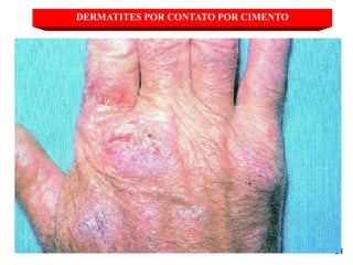 21
DERMATITES POR CONTATO POR CIMENTO
 
