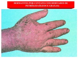 22
DERMATITES POR CONTATO COM DERIVADOS DE
PETRÓLEO (ÓLEOS E GRAXAS)
 