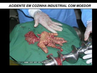 ACIDENTE EM COZINHA INDUSTRIAL COM MOEDOR
 