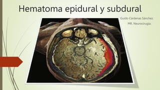 Hematoma epidural y subdural
Guido Cárdenas Sánchez.
MR. Neurocirugía.
 