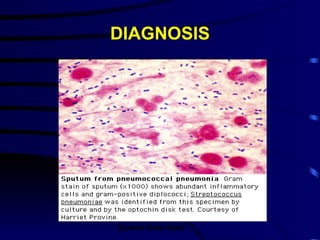 DIAGNOSIS Sputum Gram Stain 