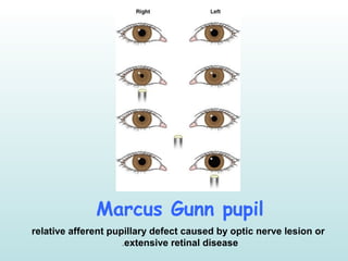 Marcus Gunn pupil
relative afferent pupillary defect caused by optic nerve lesion or
extensive retinal disease.
 