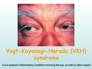 Vogt-Koyanagi-Harada (VKH)
syndrome
it is a systemic inflammatory condition involving the eye, as well as other organs
 