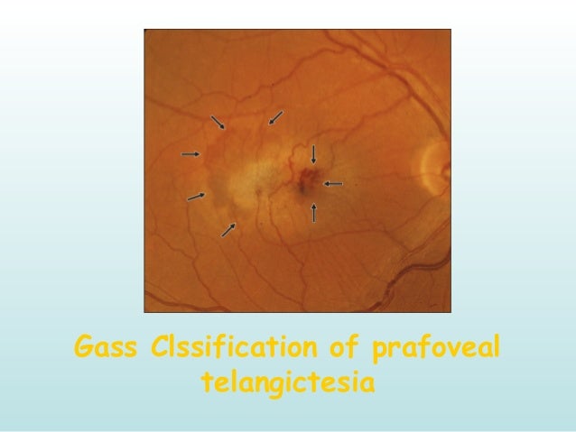 gas bubble detached retina gas bubble detached retina