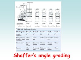 Shaffer’s angle grading
 