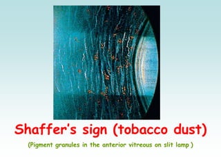 Shaffer’s sign (tobacco dust)
(Pigment granules in the anterior vitreous on slit lamp )
 