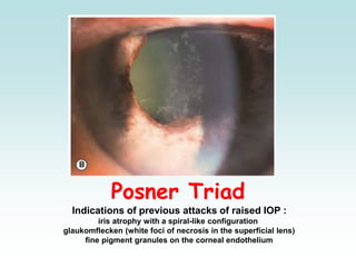 Posner Triad
Indications of previous attacks of raised IOP :
iris atrophy with a spiral-like configuration
glaukomflecken (white foci of necrosis in the superficial lens)
fine pigment granules on the corneal endothelium
 
