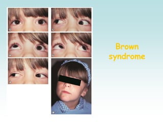 Brown
syndrome
 