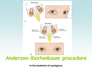 Anderson-Kestenbaum procedure
In the treatment of nystagmus
 
