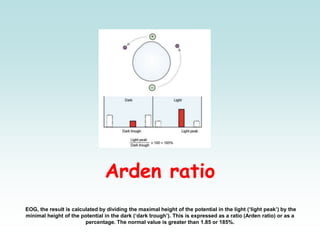 Arden ratio
EOG, the result is calculated by dividing the maximal height of the potential in the light (‘light peak’) by the
minimal height of the potential in the dark (‘dark trough’). This is expressed as a ratio (Arden ratio) or as a
percentage. The normal value is greater than 1.85 or 185%.
 