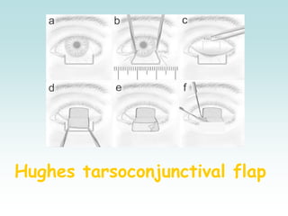 Hughes tarsoconjunctival flap
 