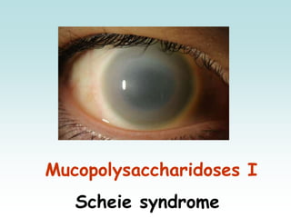 Mucopolysaccharidoses I
Scheie syndrome
 
