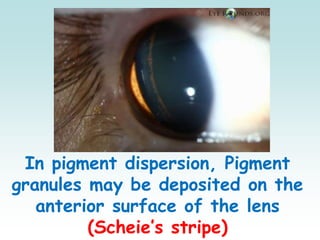 In pigment dispersion, Pigment
granules may be deposited on the
anterior surface of the lens
(Scheie’s stripe)
 