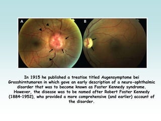 In 1915 he published a treatise titled Augensymptome bei
Grosshirntumoren in which gave an early description of a neuro-ophthalmic
disorder that was to become known as Foster Kennedy syndrome.
However, the disease was to be named after Robert Foster Kennedy
(1884–1952), who provided a more comprehensive (and earlier) account of
the disorder.
 