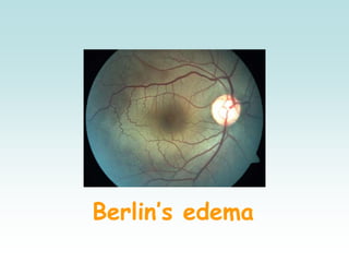Berlin’s edema
 
