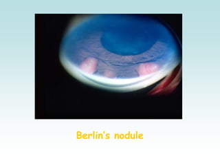 Berlin’s nodule
 
