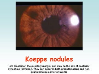 Koeppe nodules
are located on the pupillary margin, and may be the site of posterior
synechiae formation. They can occur in both granulomatous and non-
granulomatous anterior uveitis
 