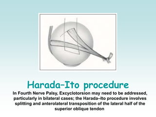Harada–Ito procedure
In Fourth Nerve Palsy, Excyclotorsion may need to be addressed,
particularly in bilateral cases; the Harada–Ito procedure involves
splitting and anterolateral transposition of the lateral half of the
superior oblique tendon
 