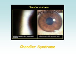 Chandler Syndrome
 