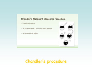 Chandler’s procedure
 