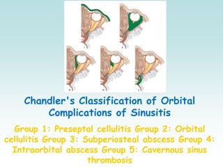 Chandler's Classification of Orbital
Complications of Sinusitis
Group 1: Preseptal cellulitis Group 2: Orbital
cellulitis Group 3: Subperiosteal abscess Group 4:
Intraorbital abscess Group 5: Cavernous sinus
thrombosis
 