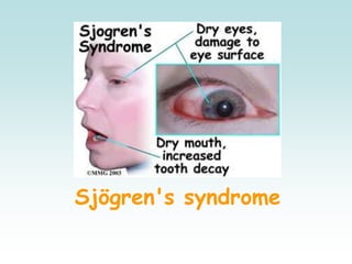 Sjögren's syndrome
 