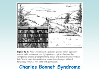 Charles Bonnet Syndrome
 