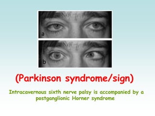 (Parkinson syndrome/sign)
Intracavernous sixth nerve palsy is accompanied by a
postganglionic Horner syndrome
 