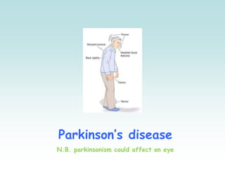 Parkinson’s disease
N.B. parkinsonism could affect on eye
 